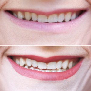 Smile Brilliant Custom Teeth Whitening System Review